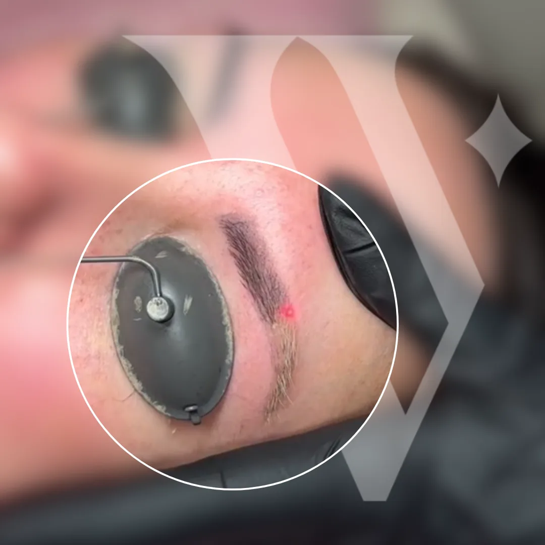 Laser tattoo removal procedure